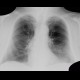 Chondrohamartoma of lingula, lung: X-ray - Plain radiograph